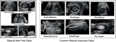 Automated deep bottleneck residual 82-layered architecture with Bayesian optimization for the classification of brain and common maternal fetal ultrasound planes